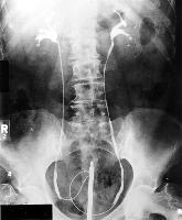 An x-ray of catheterised ureters.